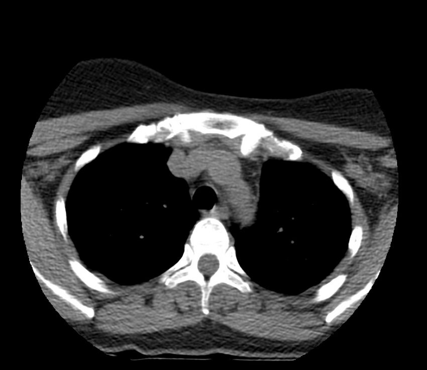 Cervical venous malformation (Radiopaedia 22653-22672 Axial non-contrast 59).jpg