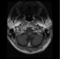 Cervical vertebrae metastasis (Radiopaedia 78814-91667 Axial T1 C+ 28).png