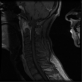 Cervical vertebrae metastasis (Radiopaedia 78814-91667 G 8).png