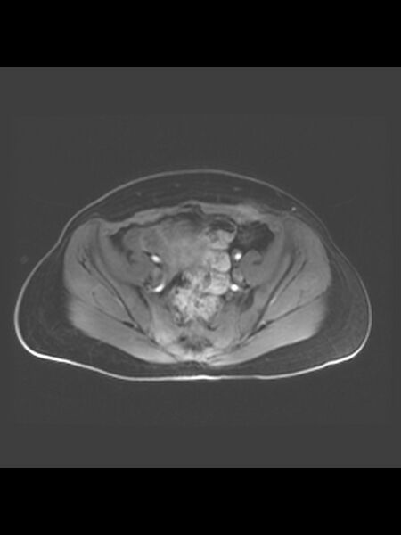 File:Cesarean section scar endometrioma (Radiopaedia 56569-63297 Axial T1 C+ fat sat 30).jpg