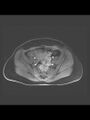 Cesarean section scar endometrioma (Radiopaedia 56569-63297 Axial T1 C+ fat sat 30).jpg