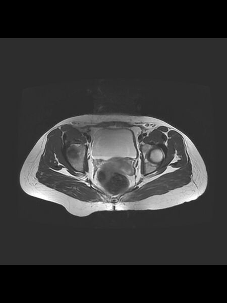 File:Cesarean section scar endometrioma (Radiopaedia 56569-63297 Axial T2 19).jpg