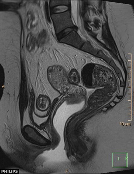 File:Cesarian scar endometriosis (Radiopaedia 68495-78066 Sagittal T2 13).jpg