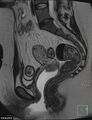 Cesarian scar endometriosis (Radiopaedia 68495-78066 Sagittal T2 13).jpg