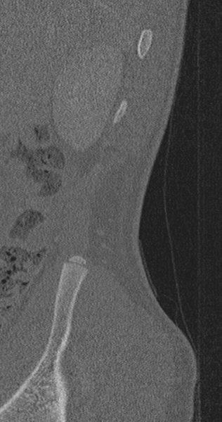 File:Chance fracture (Radiopaedia 40360-42912 Sagittal bone window 100).png