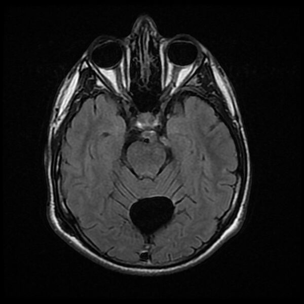 File:Chiasmatic-hypothalamic juvenile pilocytic astrocytoma (Radiopaedia 78533-91235 Axial FLAIR 11).jpg