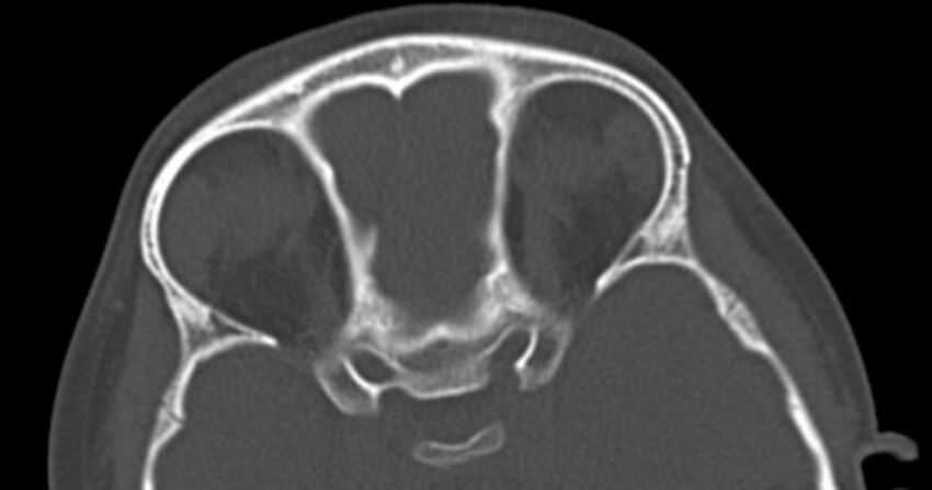 Choanal atresia (Radiopaedia 51295-56972 Axial bone window 57).jpg
