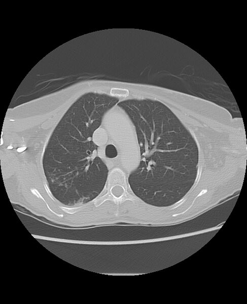 File:Chondrosarcoma (Radiopaedia 79427-92532 Axial lung window 19).jpg
