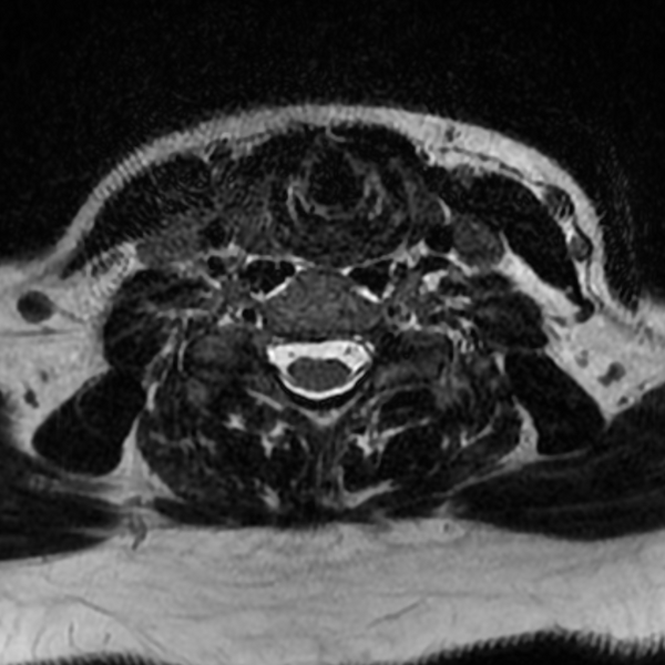 File:Chordoma - cervical spine (Radiopaedia 70084-80111 Axial T2 64).png