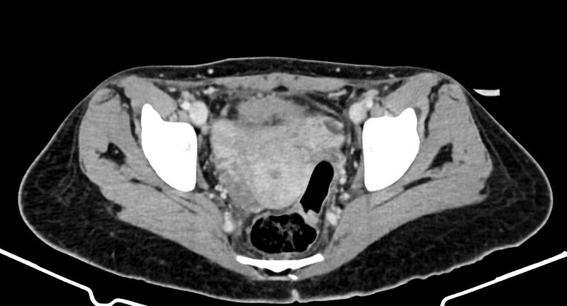 File:Choriocarcinoma liver metastases (Radiopaedia 74768-85766 A 183).jpg