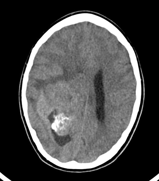File:Choroid plexus carcinoma (Radiopaedia 91013-108552 Axial non-contrast 38).jpg