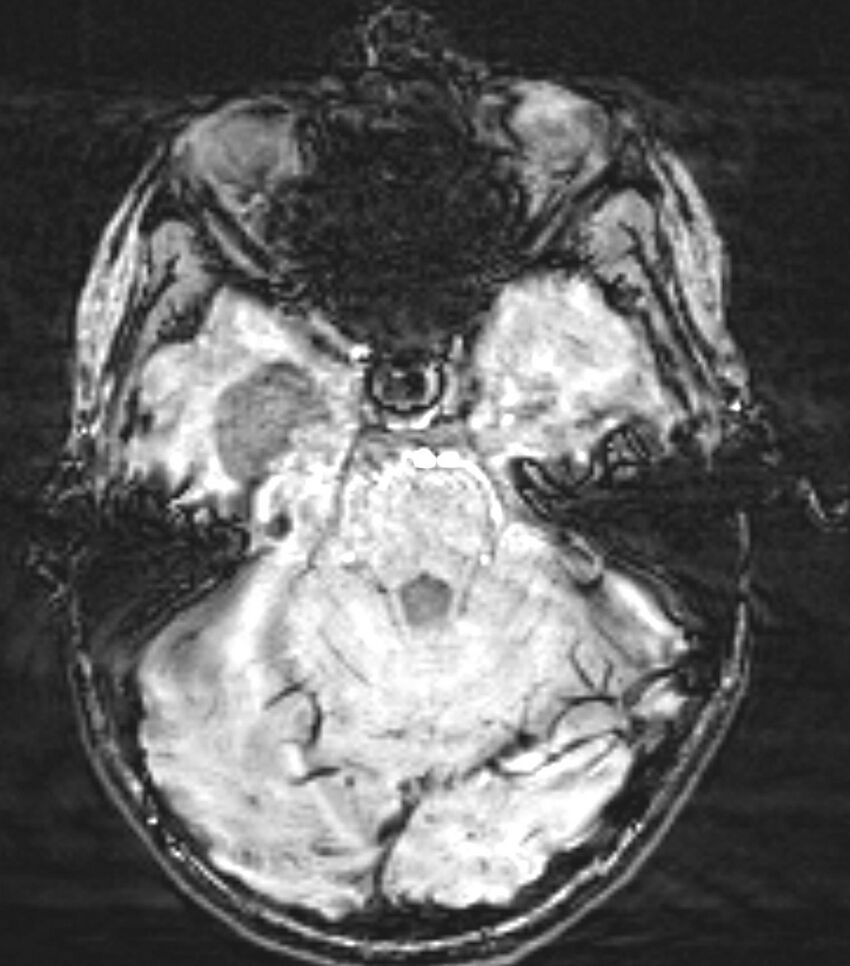 Choroid plexus carcinoma (Radiopaedia 91013-108553 Axial SWI 30).jpg