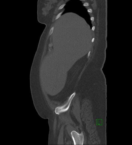 File:Chromophobe renal cell carcinoma (Radiopaedia 84239-99519 Sagittal bone window 91).jpg