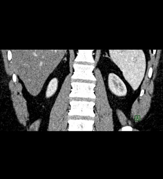 File:Chromophobe renal cell carcinoma (Radiopaedia 84286-99573 E 70).jpg