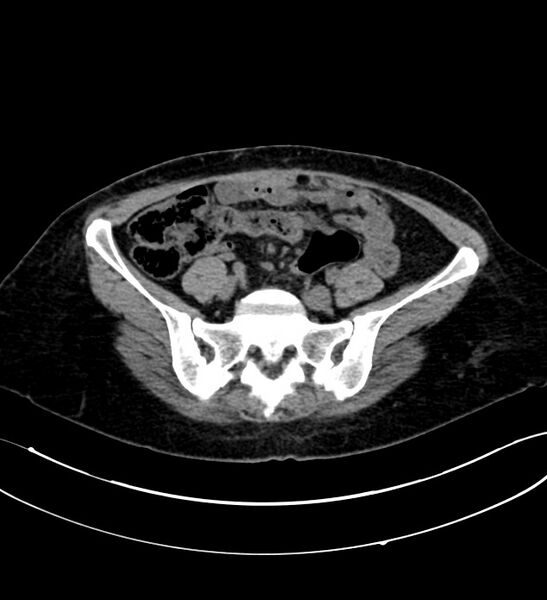 File:Chromophobe renal cell carcinoma (Radiopaedia 84290-99582 Axial non-contrast 107).jpg