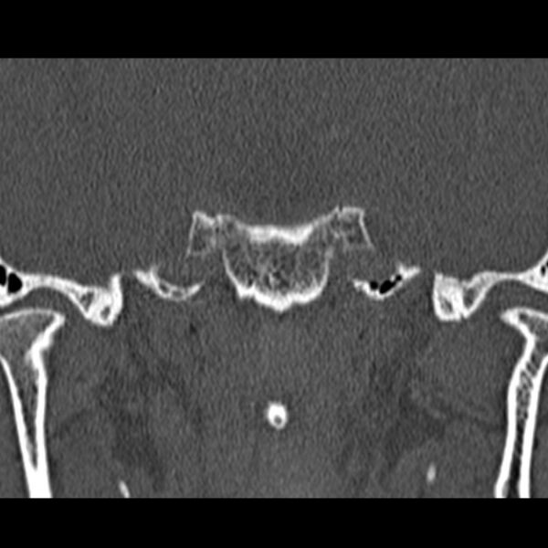 File:Chronic maxillary sinusitis (Radiopaedia 27879-28116 Coronal bone window 57).jpg