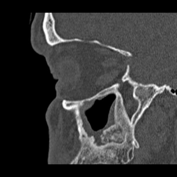 File:Chronic maxillary sinusitis (Radiopaedia 27879-28116 Sagittal bone window 42).jpg