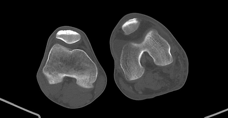 File:Chronic osteomyelitis (with sequestrum) (Radiopaedia 74813-85822 Axial non-contrast 184).jpg