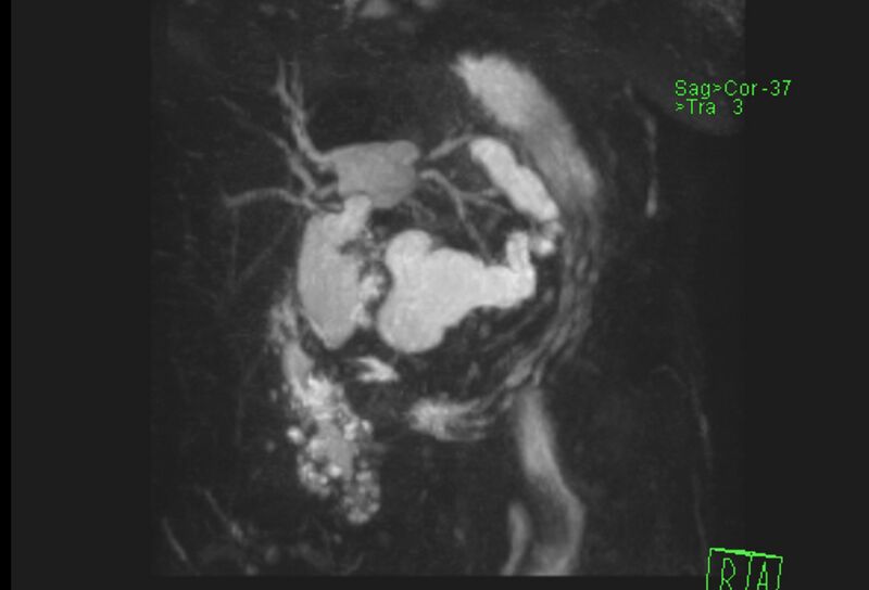 File:Chronic pancreatitis - pancreatic duct calculi (Radiopaedia 71818-82250 MRCP T2 4).jpg