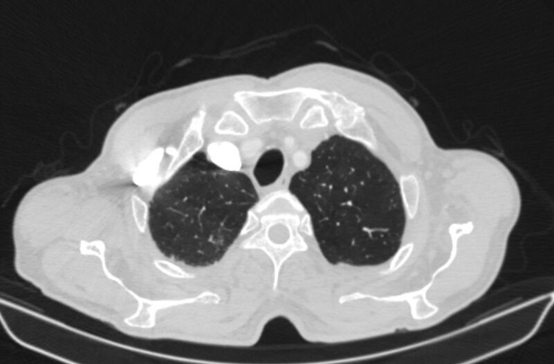 File:Chronic pulmonary embolism (Radiopaedia 91241-108843 Axial lung window 11).jpg