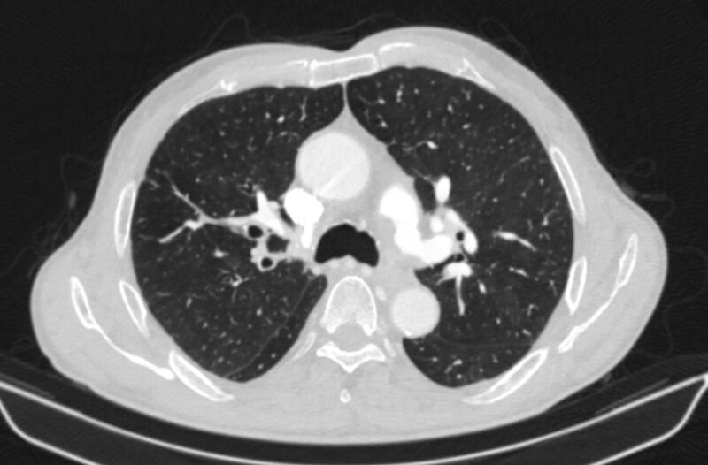 File:Chronic pulmonary embolism (Radiopaedia 91241-108843 Axial lung window 34).jpg