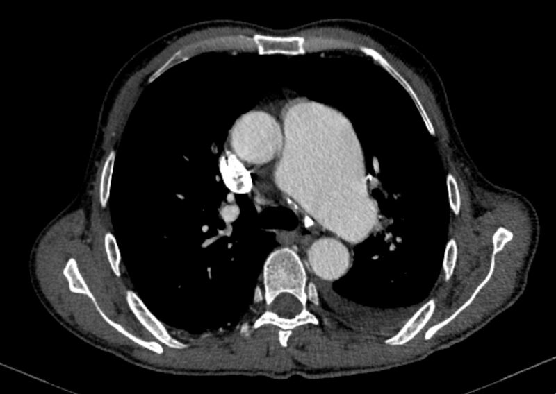 File:Chronic pulmonary embolism with bubbly consolidation (Radiopaedia 91248-108850 C+ arterial phase 56).jpg