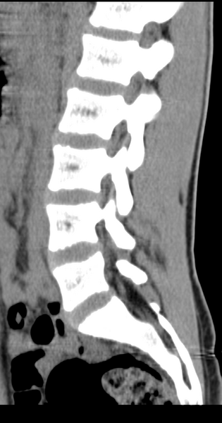 File:Clear cell meningoma - lumbar spine (Radiopaedia 60116-67691 A 26).png