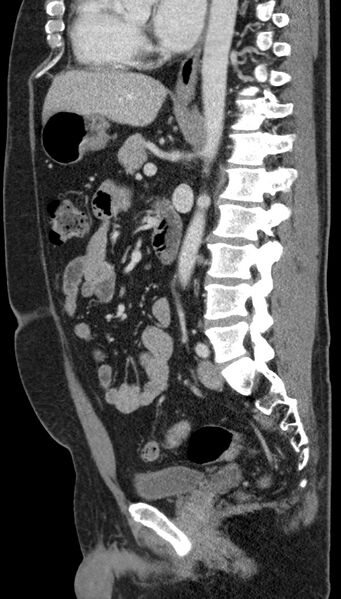 File:Clear cell renal cell carcinoma (Radiopaedia 61449-69393 G 50).jpg