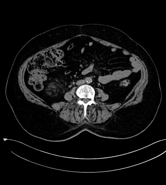File:Clear cell renal cell carcinoma (Radiopaedia 85004-100537 Axial non-contrast 27).jpg