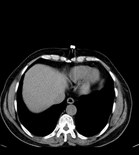 File:Clear cell renal cell carcinoma (Radiopaedia 85006-100539 Axial non-contrast 14).jpg