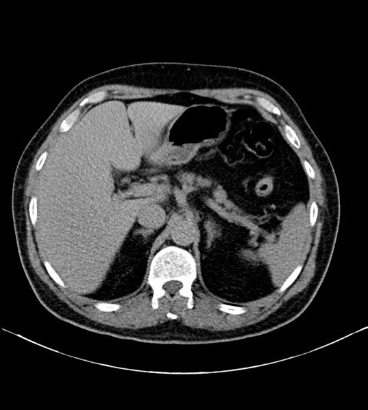 File:Clear cell renal cell carcinoma (Radiopaedia 85006-100539 H 4).jpg