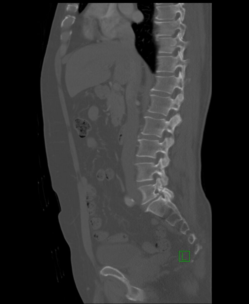Clear cell renal cell carcinoma (Radiopaedia 85006-100539 Sagittal bone window 34).jpg