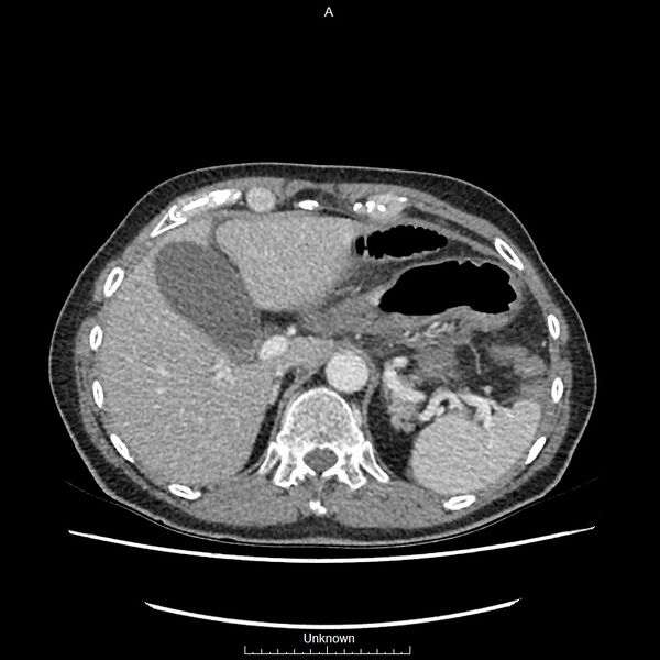 File:Closed loop bowel obstruction and ischemia (Radiopaedia 86959-103180 A 11).jpg