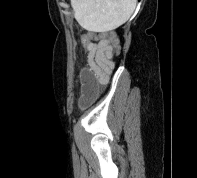 File:Closed loop small bowel obstruction (Radiopaedia 71211-81508 C 148).jpg