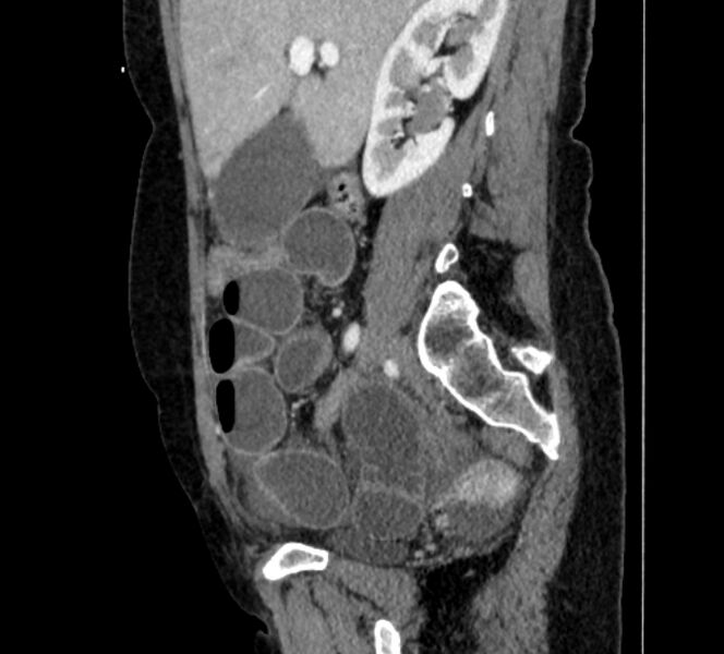 File:Closed loop small bowel obstruction (Radiopaedia 71211-81508 C 44).jpg