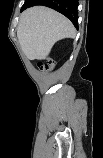 File:Closed loop small bowel obstruction - internal hernia (Radiopaedia 57806-64778 C 97).jpg