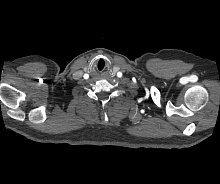 File:Coarctation of the aorta (Radiopaedia 53752-59822 A 7).jpg