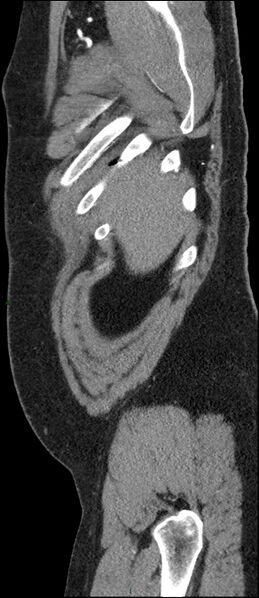 File:Coarctation of the aorta (Radiopaedia 74632-88521 C 20).jpg