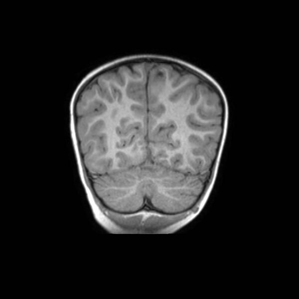 File:Cochlear nerve aplasia - unilateral (Radiopaedia 87910-104413 Coronal T1 42).jpg
