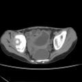 Colocolic fistula - Crohn disease (Radiopaedia 57063-63955 A 80).jpg