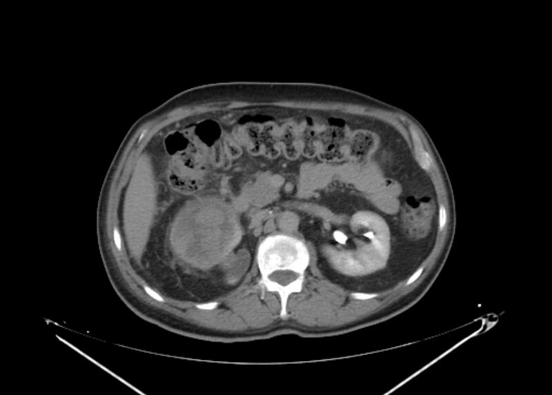 File:Colon cancer mimicking renal cell carcinoma (Radiopaedia 28986-29335 Axial C+ delayed 28).jpg