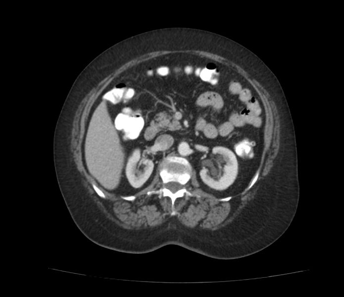 File:Colonic diverticulosis (Radiopaedia 22934-22957 A 27).jpg