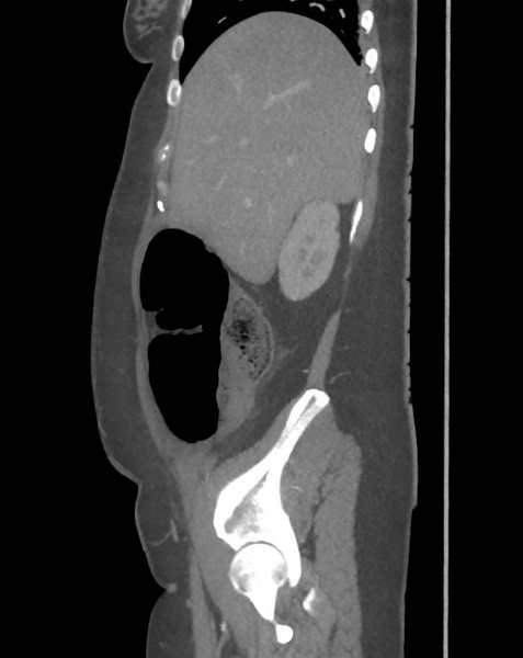 File:Colonic pseudo-obstruction (Radiopaedia 79752-92980 C 21).png