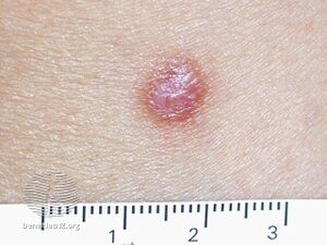 Dermatofibroma (DermNet NZ lesions-dermatofibroma-2399).jpg
