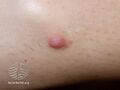 Dermatofibroma (DermNet NZ lesions-dermfib3).jpg