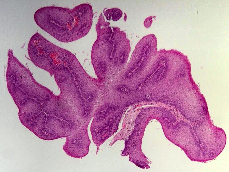 File:Esophageal squamous papilloma (Radiopaedia 54202).jpg