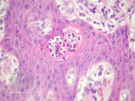 Blastomycosis-like pyoderma/pathology