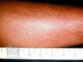 Lichen amyloidosis (DermNet NZ lichen-amyloidosis-04).jpg