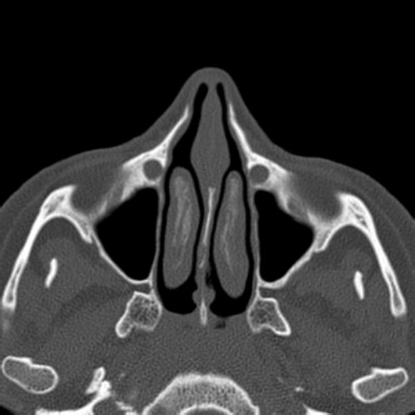 File:Nasolabial cyst (Radiopaedia 33987-35205 Axial bone window 20).jpg