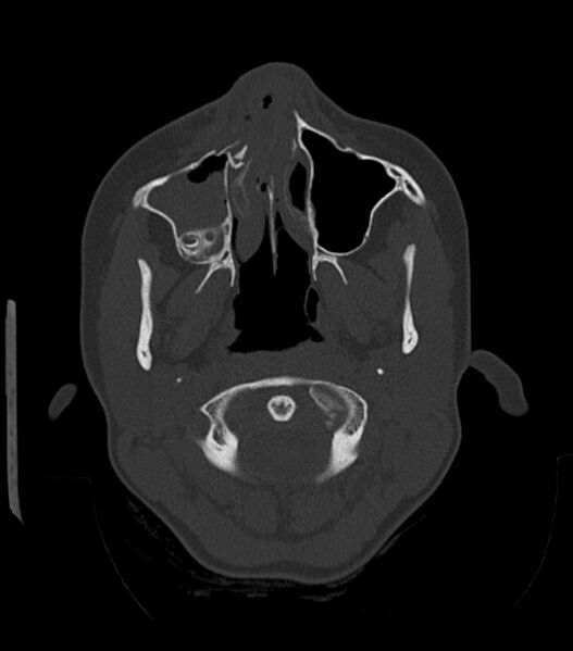 File:Nasoorbitoethmoid fracture (Radiopaedia 90044-107205 Axial bone window 59).jpg